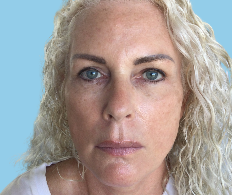 Ingrid After PDO Thread Lift