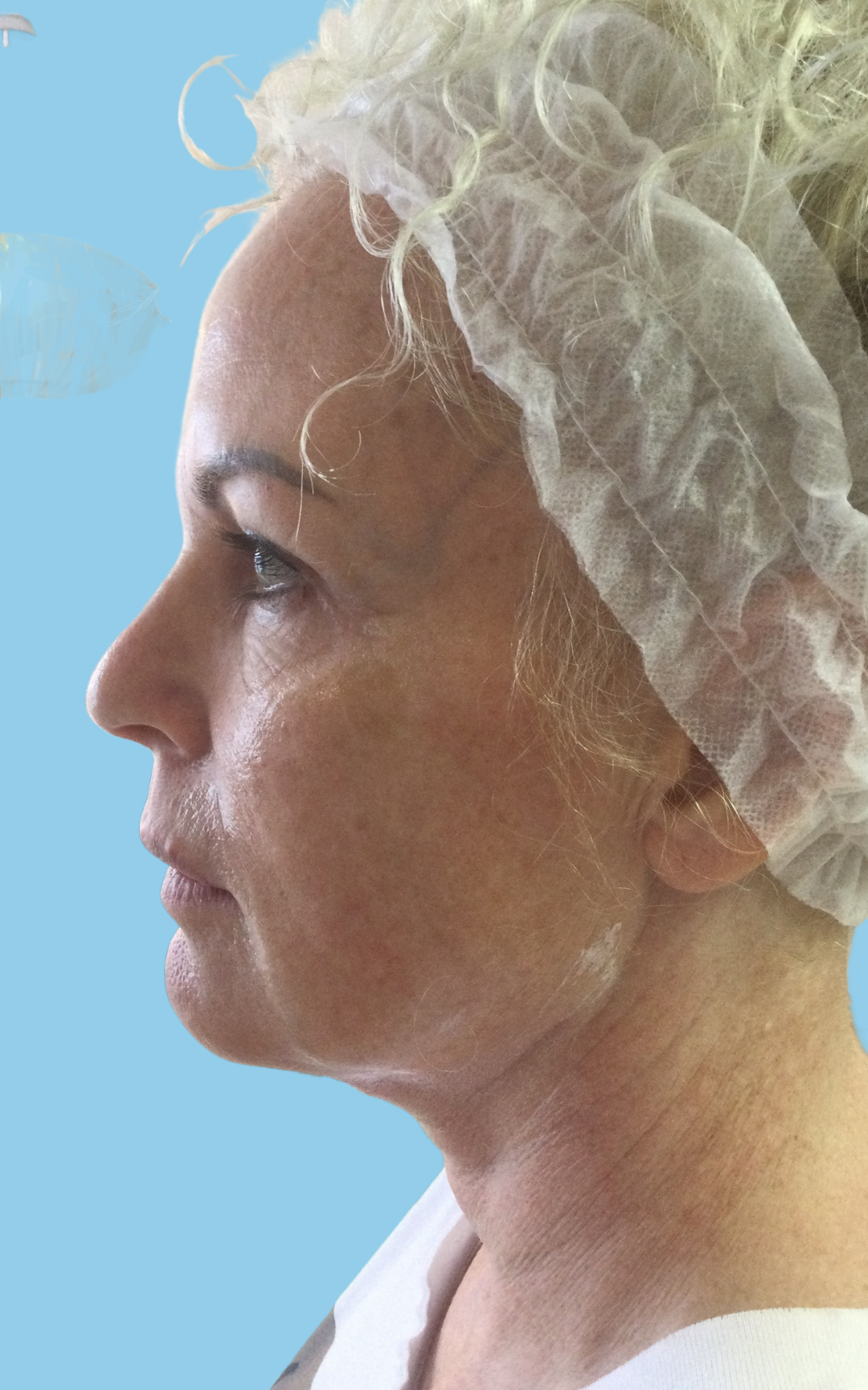 Before PDO Thread Non Surgical Threadlift