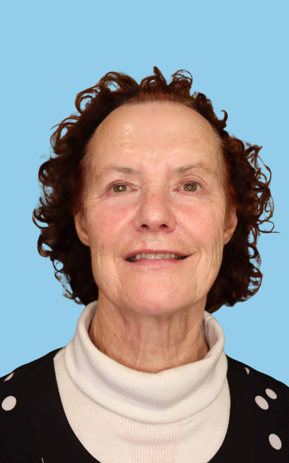 Our clients at Satini Cosmetic Clinic Christchurch Glenda, a client at Satini Cosmetic Clinic Christchurch