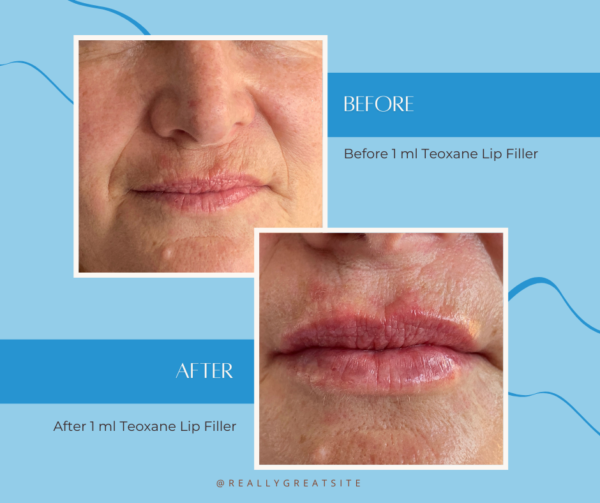Before 1 ml Teoxane Lip Filler (1) Before And After Lip Filler-Satini Cosmetic Clinic Christchurch