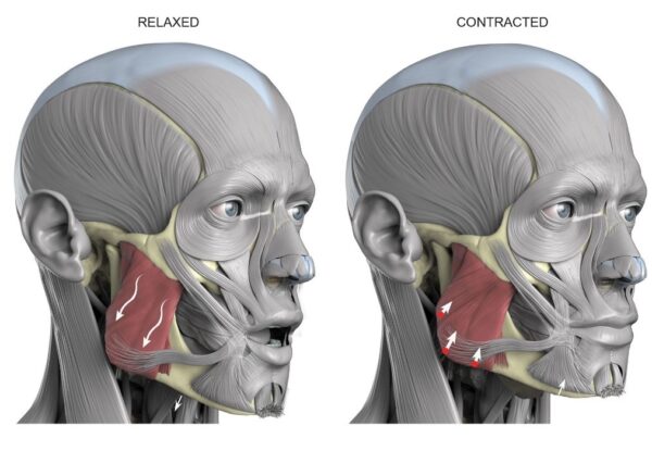 Masseter-Muscle-Hypertrophy Masseter Muscle Hypertrophy