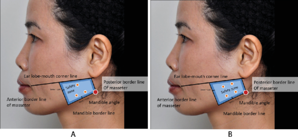 Masseter Muscle Injections Masseter Botox Placement