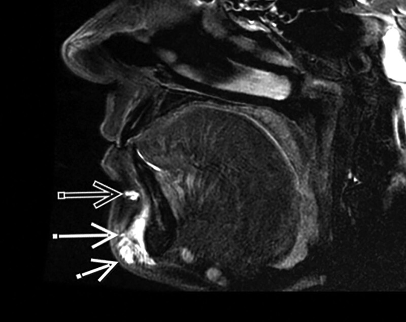 dermal filler MR scan image, chin How long do dermal fillers last?