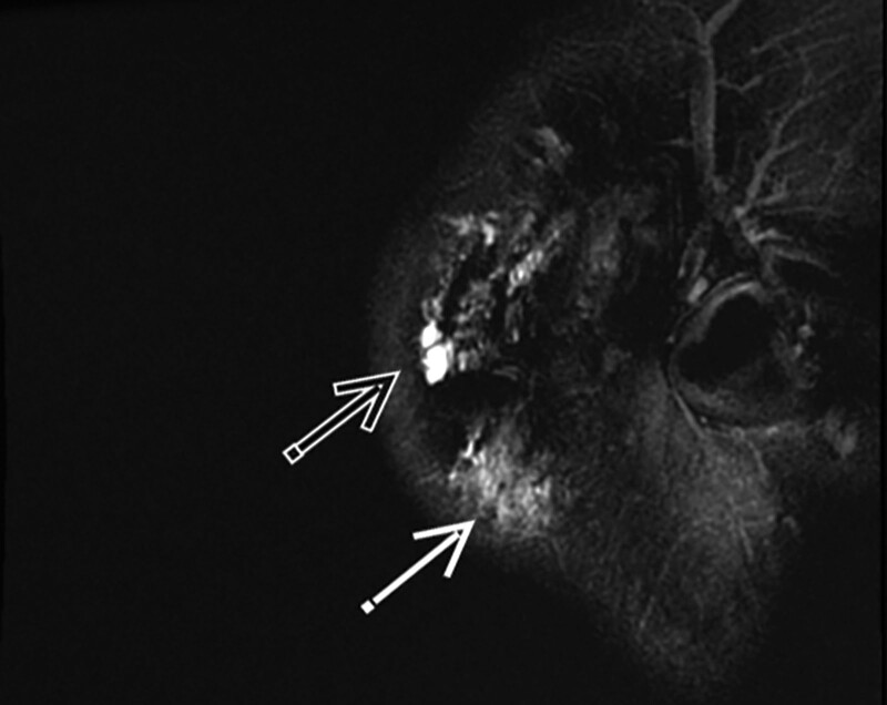 dermal filler cheek MR scan 4 Dermal filler on MR Scan after 27 months