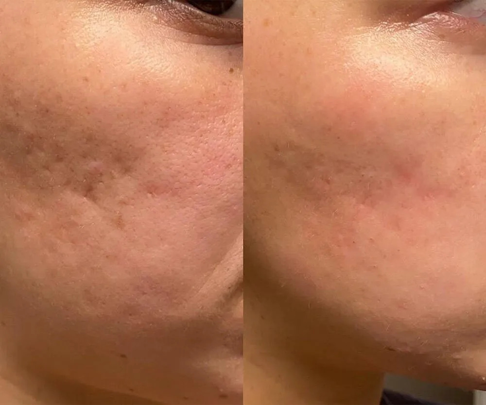 Before and after microneedling for acne scars Before and after microneedling for acne scars