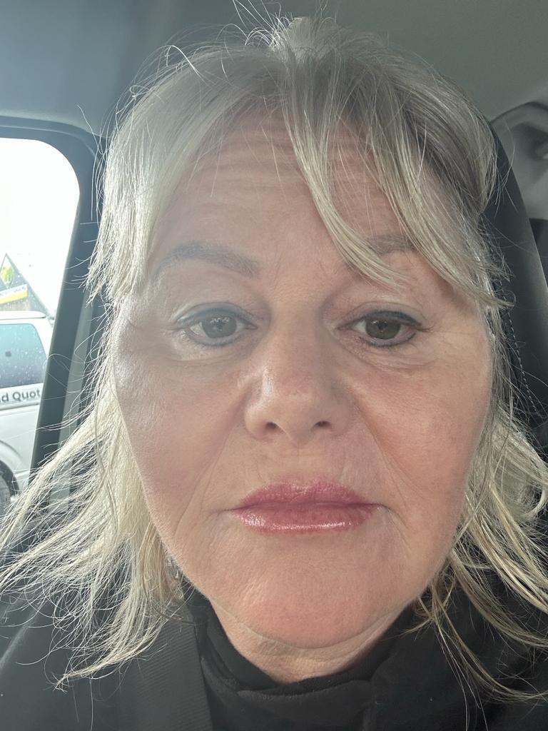 Chrissie one day after her non-surgical facelift One day after non-surgical facelift, swelling both sides of the cheeks