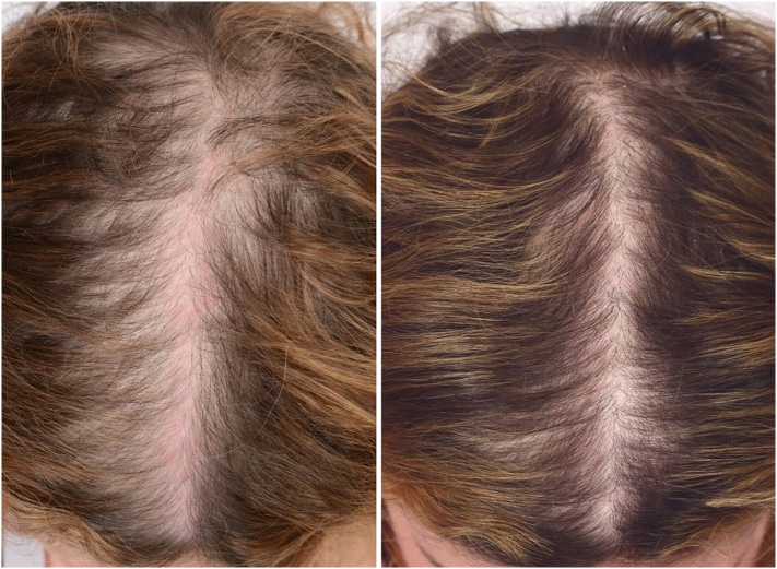 Hairloss before and after plasma Before and after PRP Plasma for hair loss