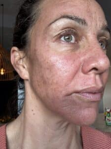 Jessie 2 days after cosmelan peel Jessie 2 days after cosmelan peel