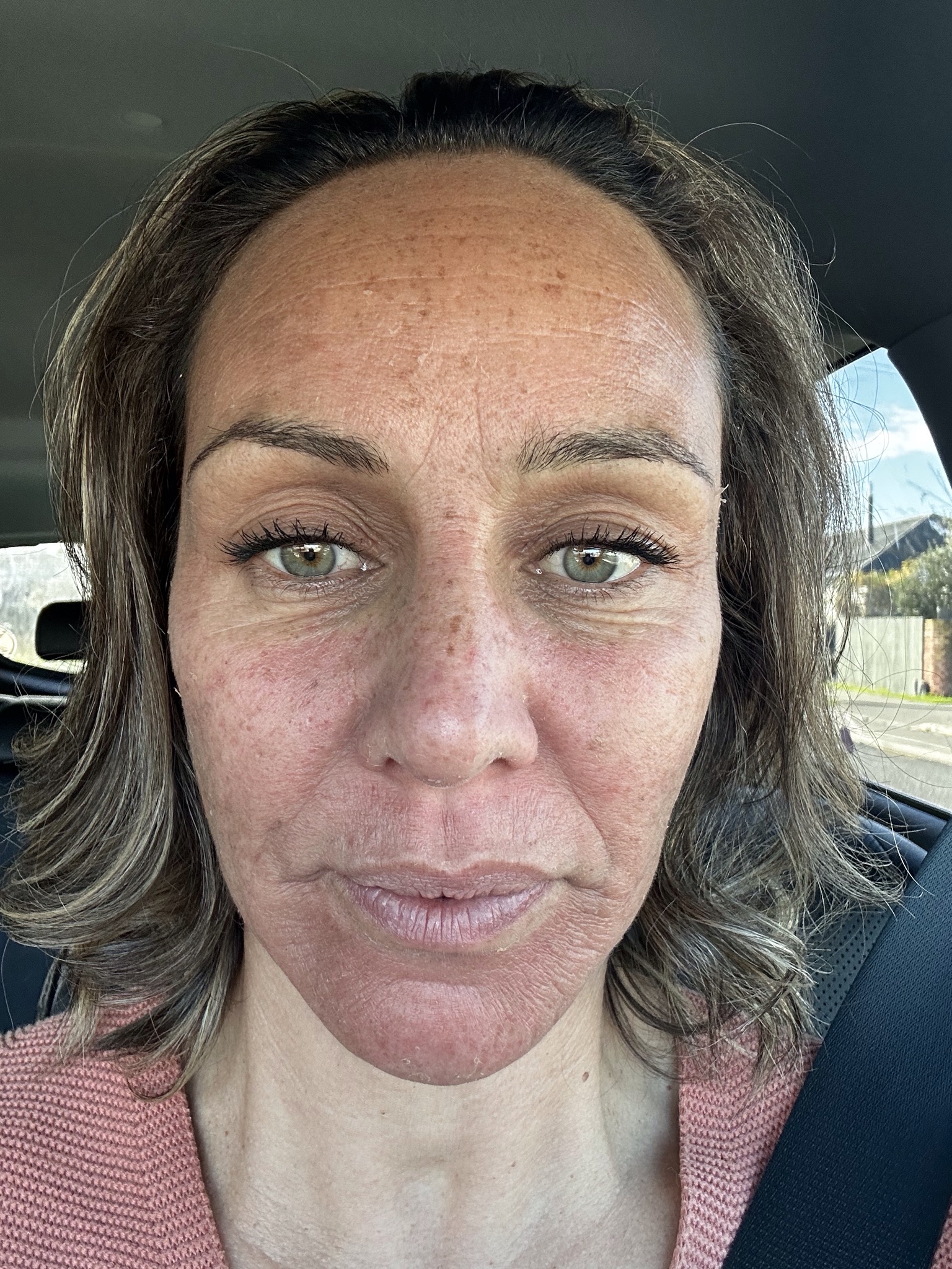 Jessie 3 days after cosmelan treatment Jessie 3 days after cosmelan
