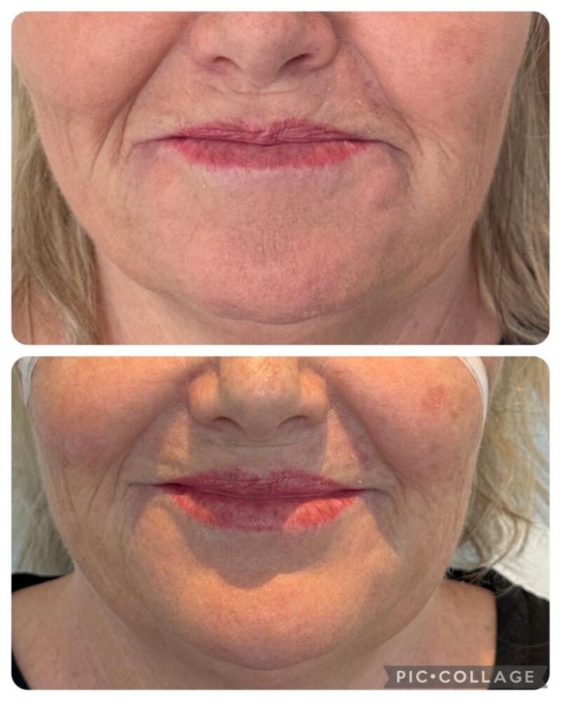 Chrissie Before And After Non-Surgical Facelift Folds between the nose and lips before and after non-surgical facelift, Chrissie