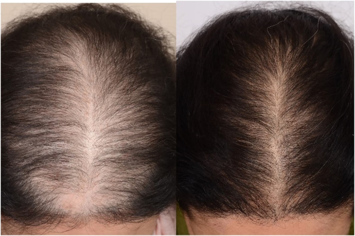 hairloss 2 Female before and after PRP Plasma for hair loss