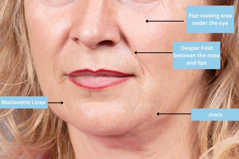 Middle aged woman before a non-surgical facelift Signs of facial sagging before a facelift