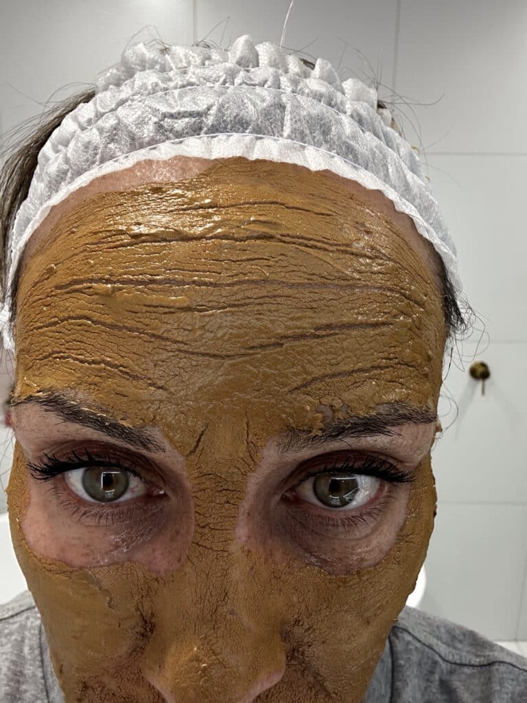 Jessie straight after her cosmelan mask After the cosmelan mask