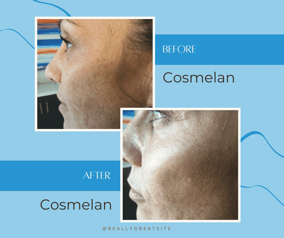 Jessie Before And After Cosmelan Before And After Jessie's Cosmelan