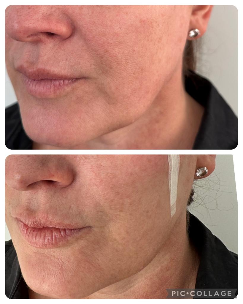Before and after non-surgical facelift Before And After Non-Surgical Facelift