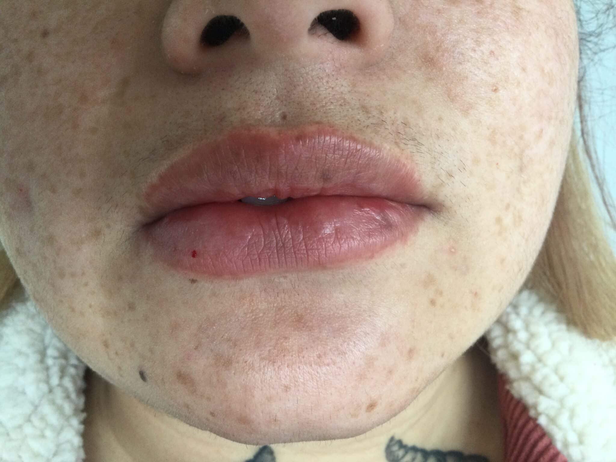 After 1 ml lip filler