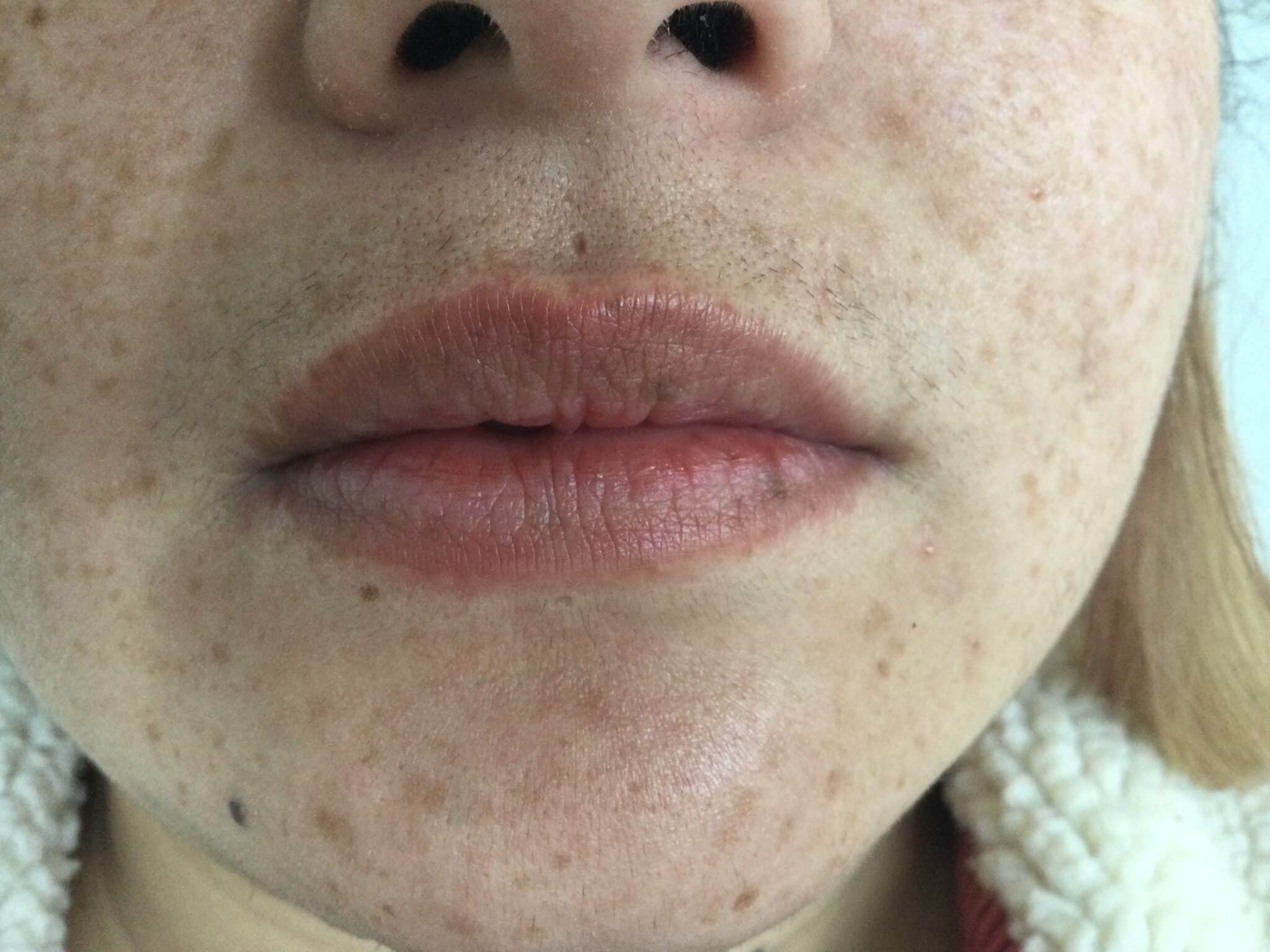 Before 1 ml lip filler