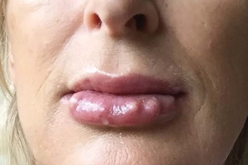 late-onset-lip-nodules-4-months-after-Volbella-injection Juvederm and lip nodules after 4 months