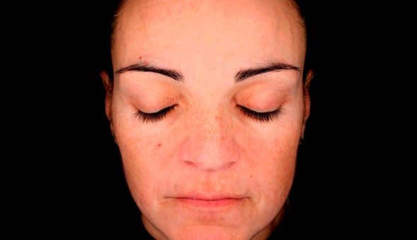 dermamelan photos, after