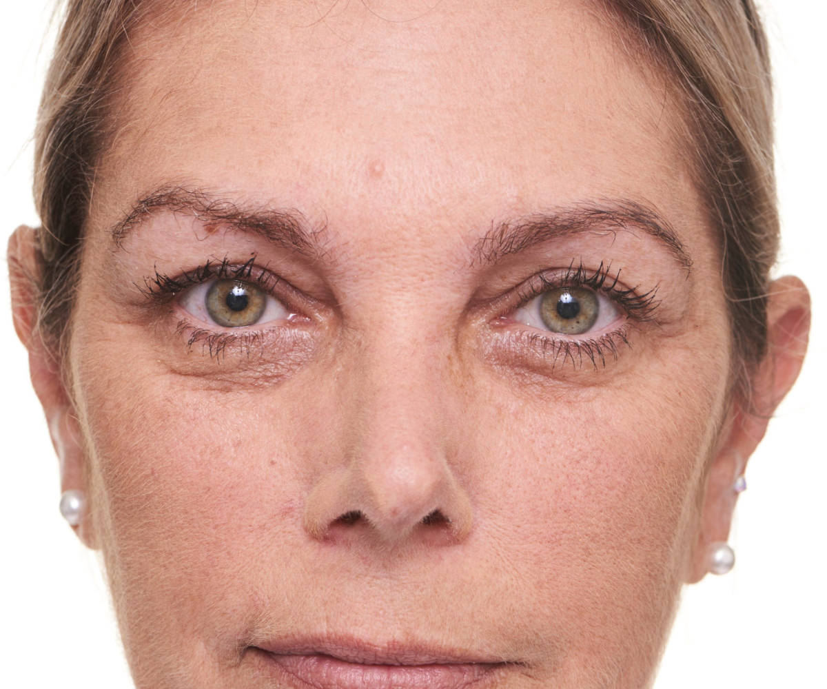 Michelle before tear trough filler