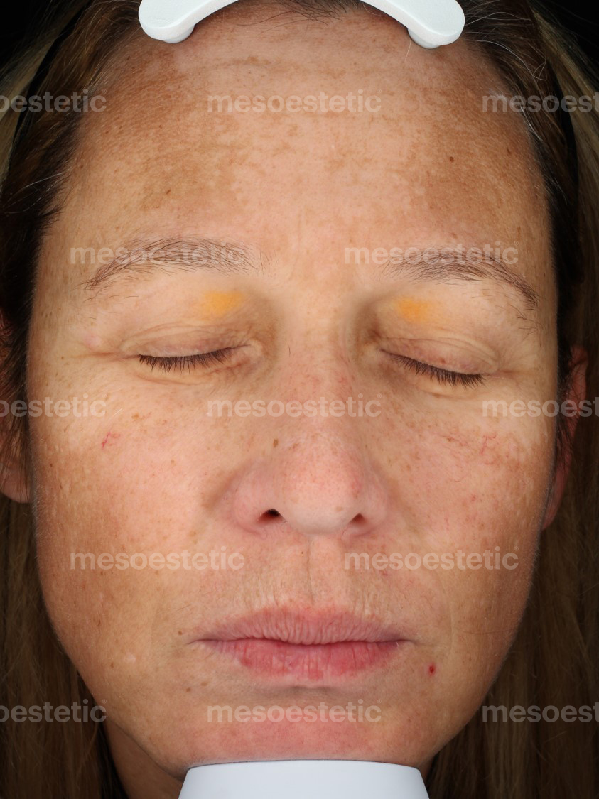 Before Dermamelan Mask