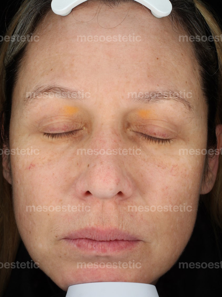 After Dermamelan Mask