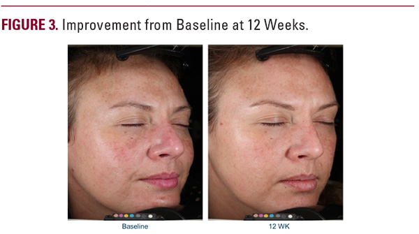 Improved uneven pigmentation over 12 weeks with non-hydroquinone cream Improved uneven pigmentation over 12 weeks with non-hydroquinone cream