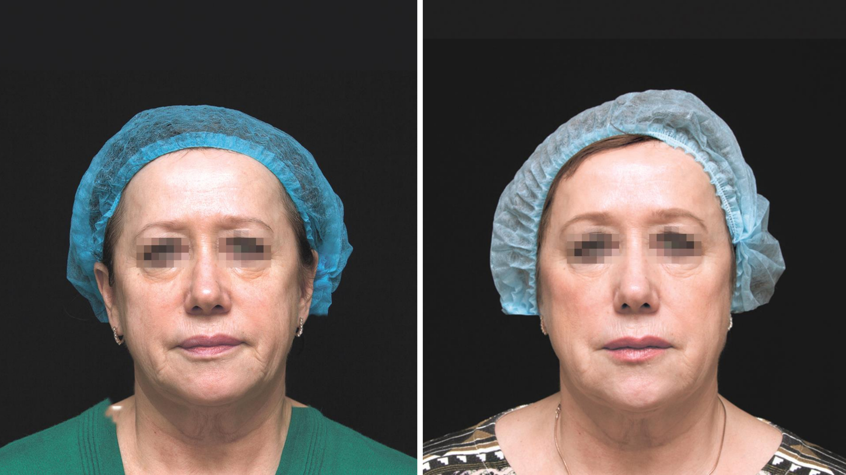 Profhilo Before And After Photos Profhilo Before And After Photos