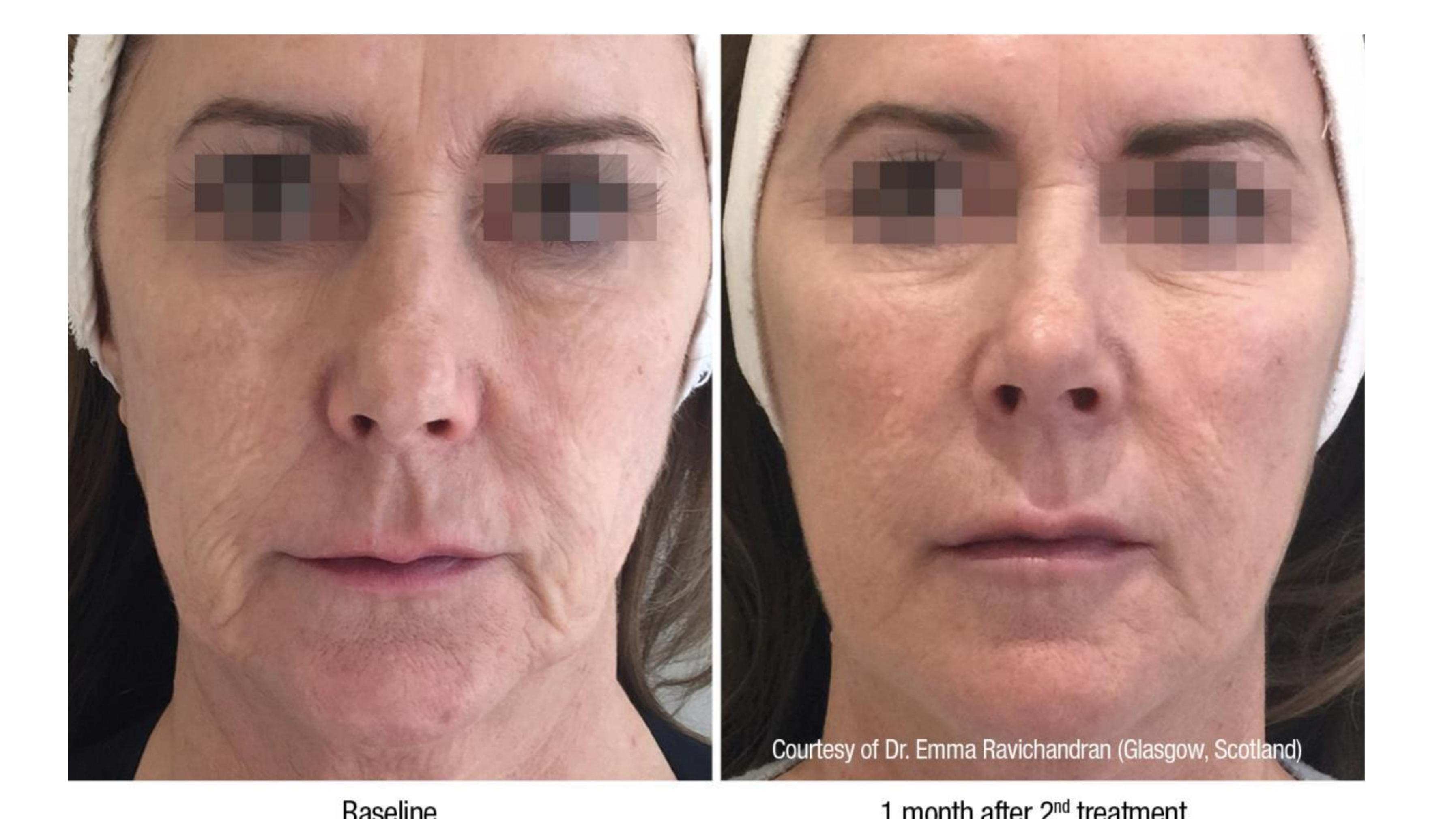 Profhilo Before And After Photos Profhilo Before And After Photos