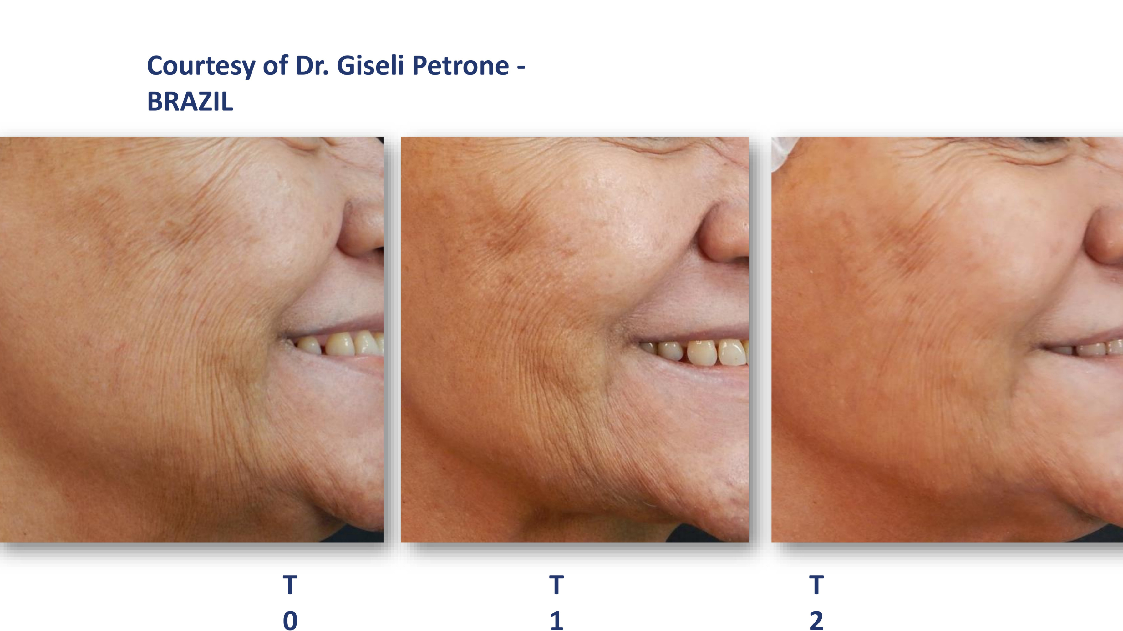 Profhilo Before And After Photos Profhilo Before And After Photos