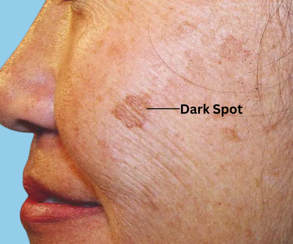 Dark Spot Face Sark Spot Face