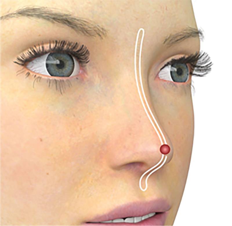 Nose enhancement Nose thread lift at Satini Cosmetic Clinic