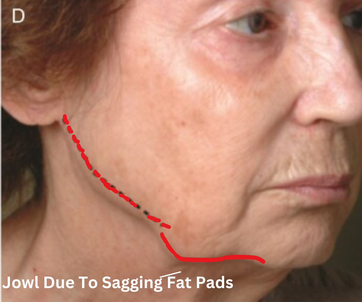 Jowl Due To Sagging Fat Pads Jowl Due To Sagging Fat Pads
