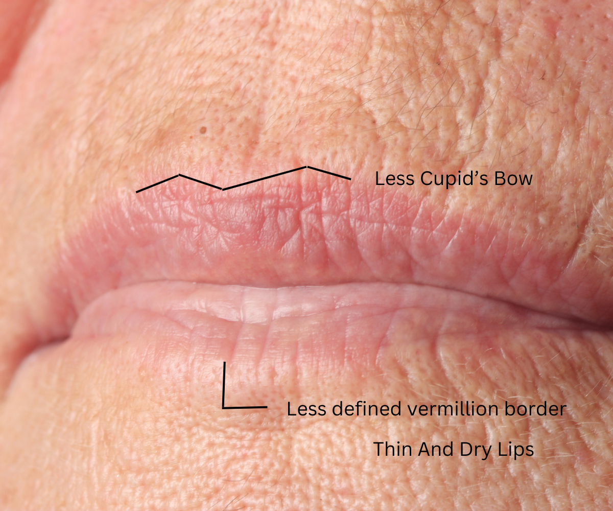 Less defined vermillion border Thin lips mature woman