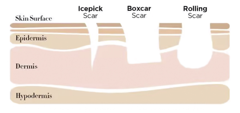 Infographic_Acne_Scars_grande1