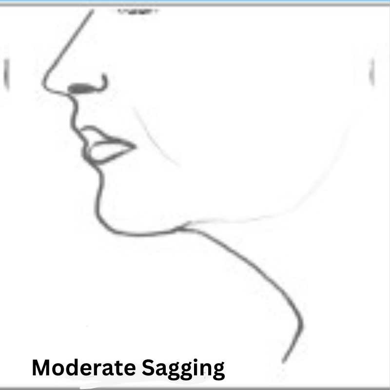 Moderate neck sagging Moderate neck sagging