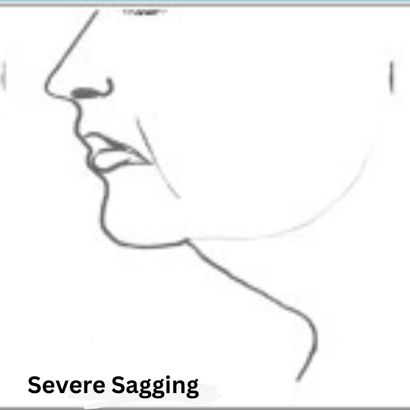 Severe neck sagging Severe neck sagging