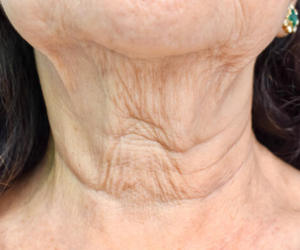 Neck wrinkles in mature woman Neck wrinkles in mature woman