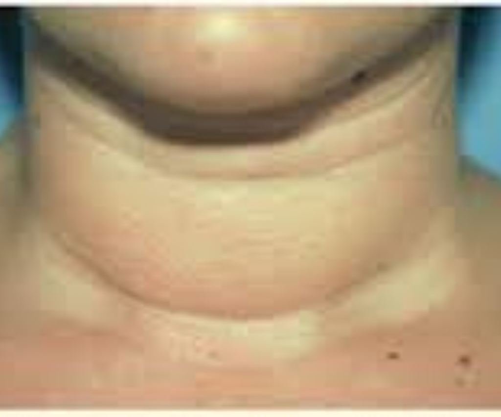 Excessive fat neck Excessive fat neck