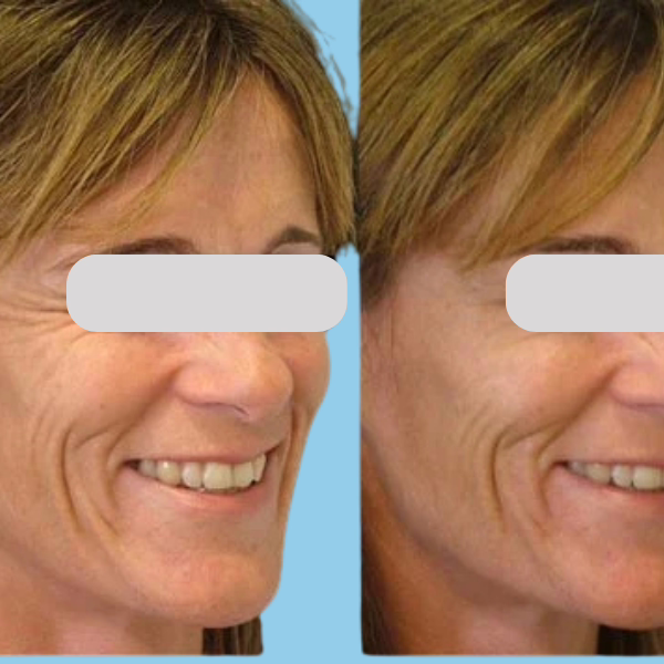 73614883-eb26-4826-ba61-365488875f38 Before and after Botox for crows feet
