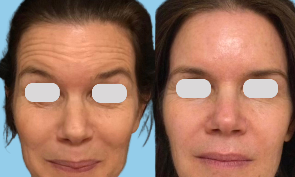 ba25844b-e2d6-4725-abc5-6f1b82a667aa 42 year old woman before and after Botox for the forehead and frown lines.