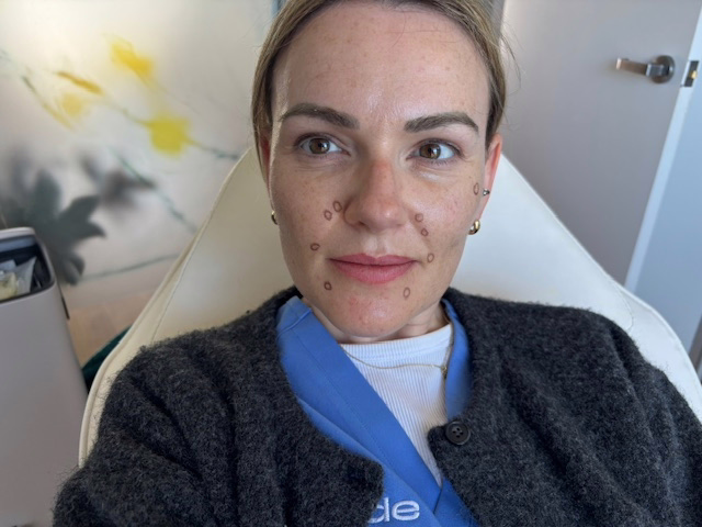 Injection Points of Sunekos 1200, first treatment with Sunekos