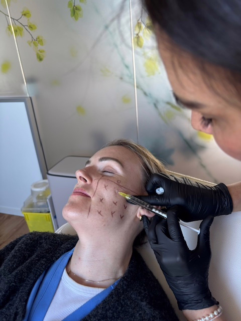 Markings prior to Sunekos treatment on the cheek