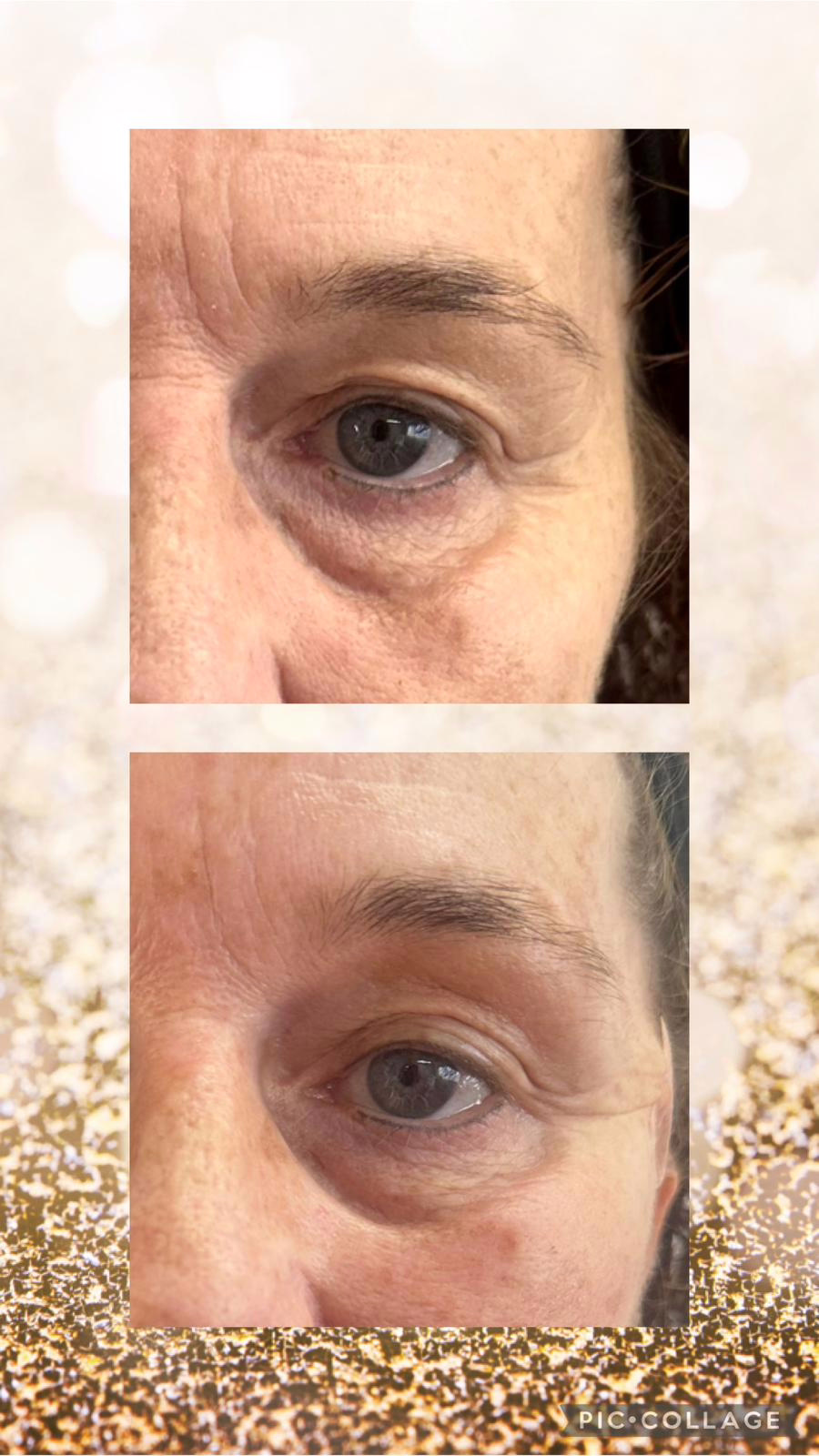 Sunekos Treatment For The Under-Eye-Area, Before And After Photos