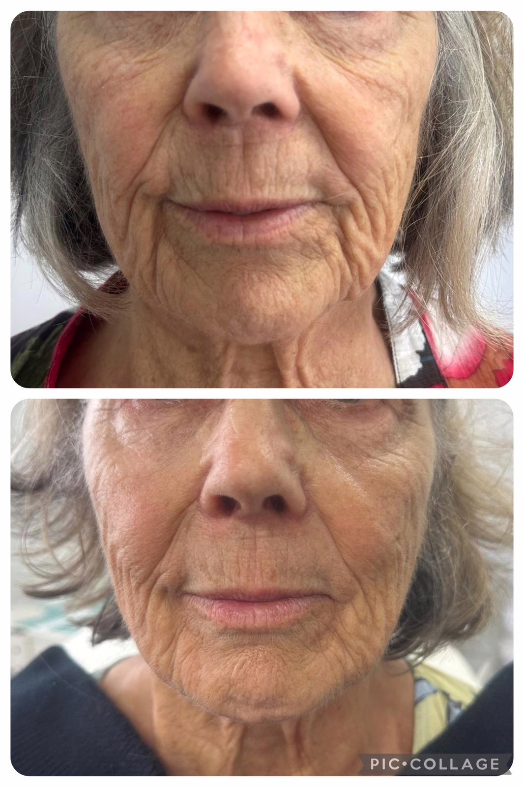 Before and after Sunekos at Satini Cosmetic Clinic-Christchurch