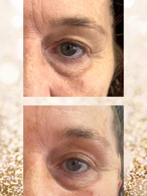 Sunekos before And After-Under Eye Area